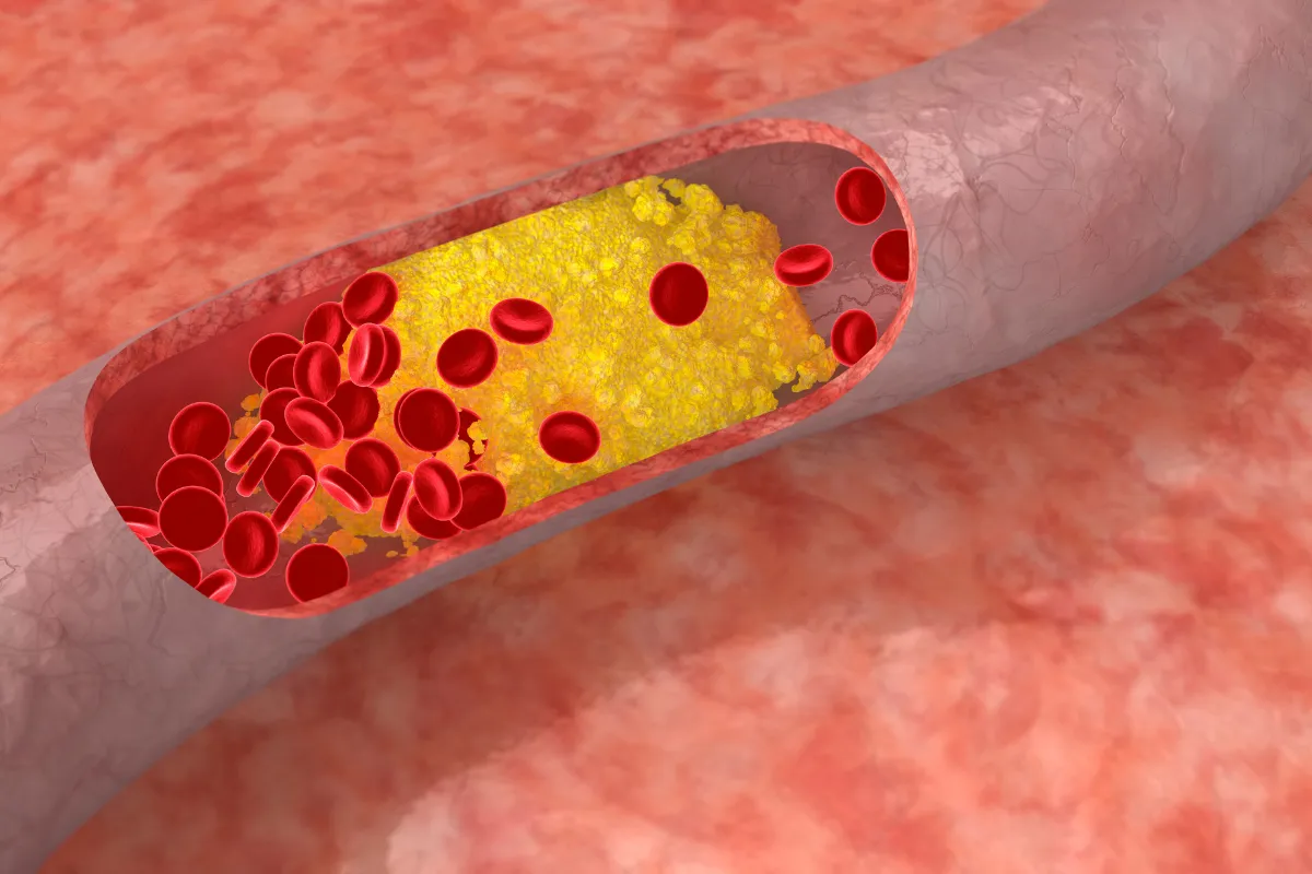 Managing High Cholesterol: Dietary Changes For Spring, Tx Residents 2 Unhealthy Foods High In Cholesterol